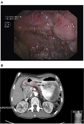 Gastric Adenocarcinoma Presenting as a Rheumatoid Factor and Anti-cyclic Citrullinated Protein Antibody-Positive Polyarthritis: A Case Report and Review of Literature